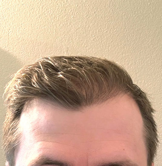 Nashville Hair Doctor patient 7 months after NeoGraft hair transplant - front view