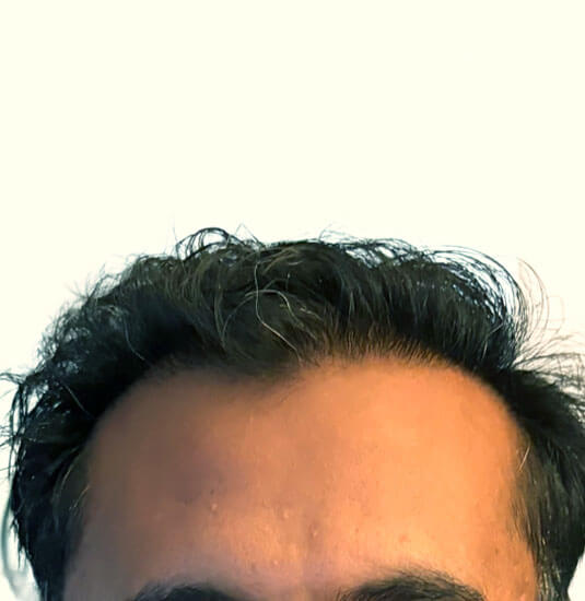 Nashville Hair Doctor patient 7 months after NeoGraft hair transplant - front view
