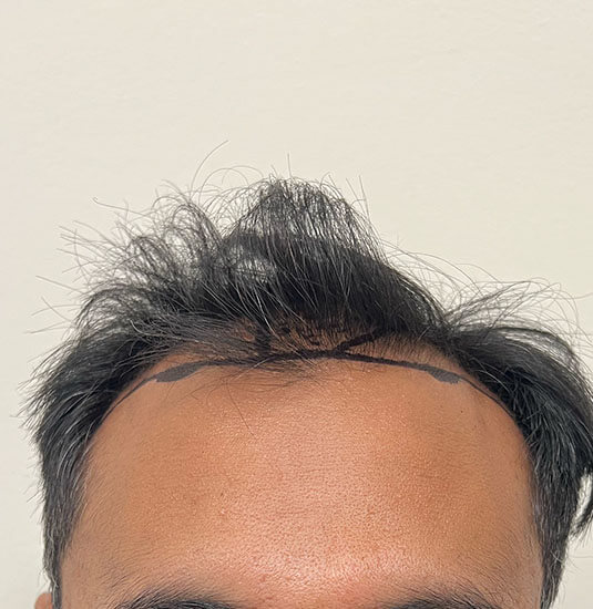 Nashville Hair Doctor patient before NeoGraft hair transplant - front view