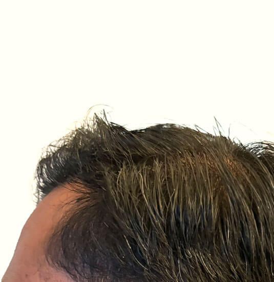 Nashville Hair Doctor patient 7 months after NeoGraft hair transplant - left view