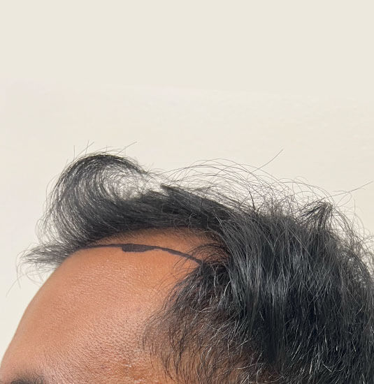 Nashville Hair Doctor patient before NeoGraft hair transplant - left view