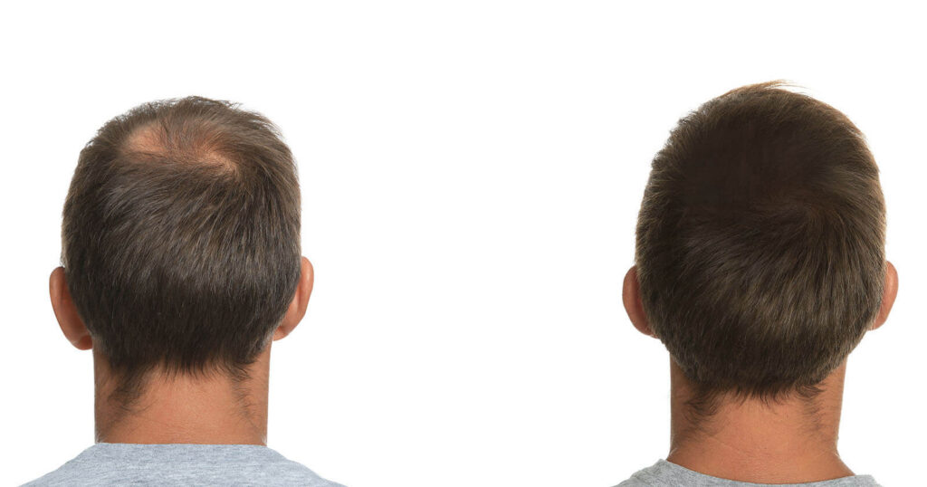 hair restoration patient viewed from the back view before and after procedure