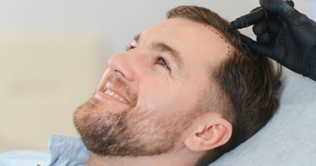 male patient having new hairline drawn on his head by a hair restoration technician prior to his procedure